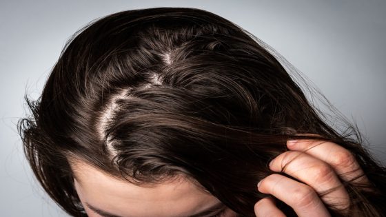 وصفات لتساقط الشعر