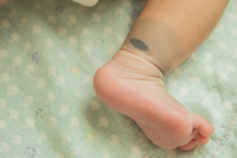 البقع المنغولية عند الأطفال الرضع أسباب وعلاج