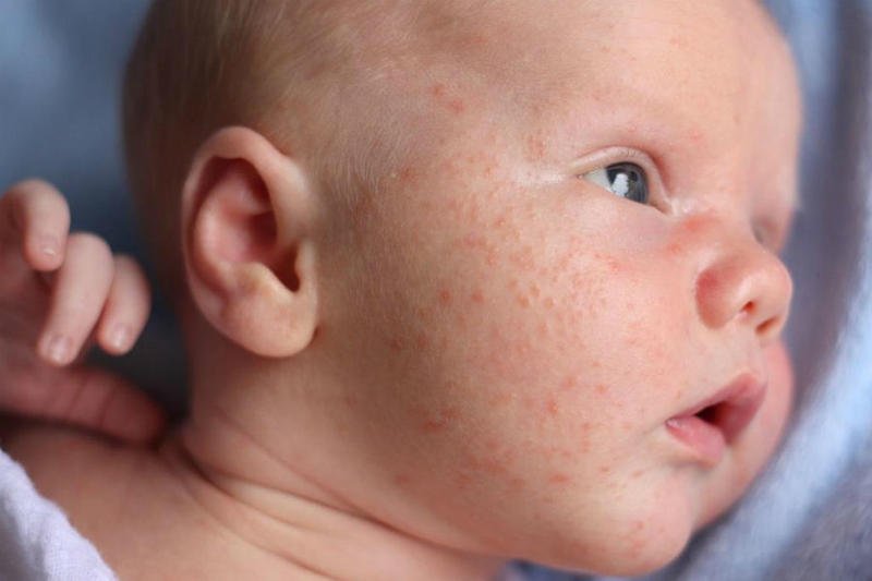 أعراض حساسية الجلد المفاجئة عند الأطفال