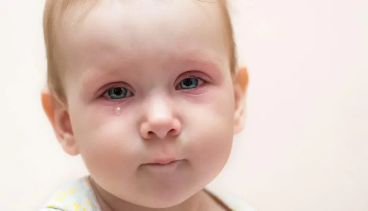علاج رمد العين للأطفال