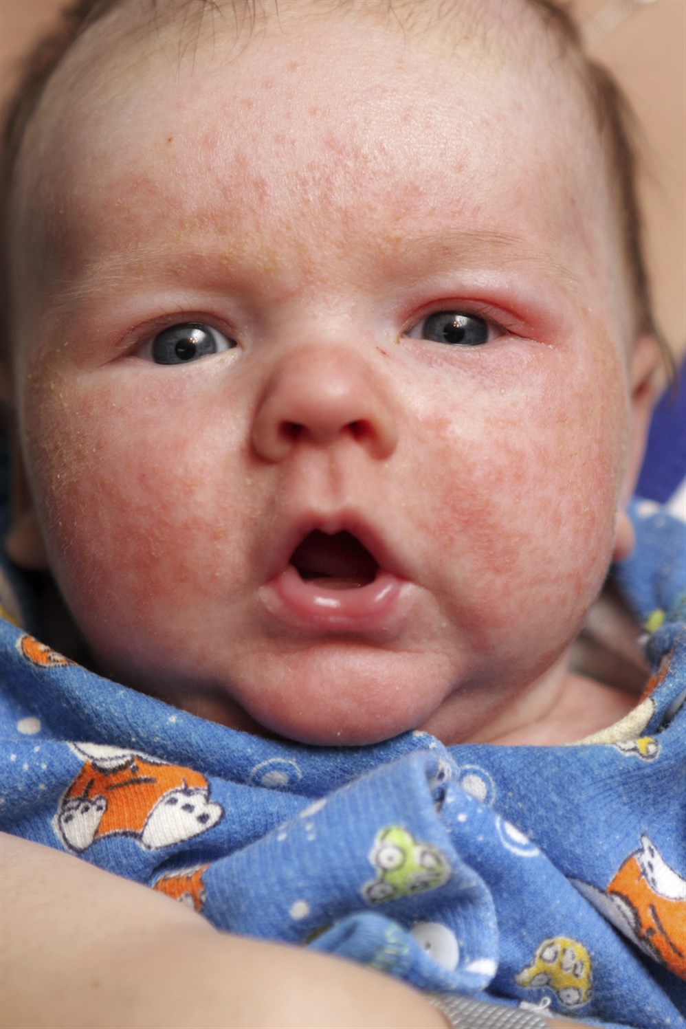 كيفية علاج الأكزيما لدى الرضع