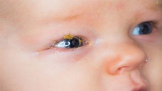 أفضل طريقة لإزالة إفرازات العين عند الرضع