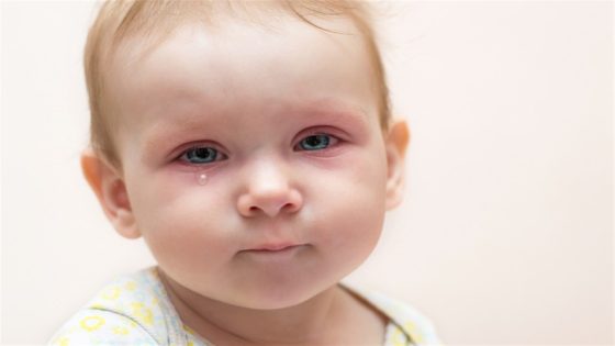 علاج رمد العين عند حديثي الولادة
