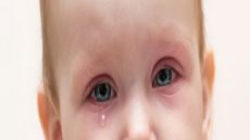 ظهور نقط حمراء حول العين عند الأطفال
