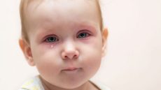 كيفية الاعتناء بالطفل المصاب بالتهاب الملتحمة