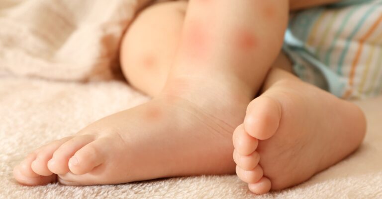 أسباب الحساسية عند الأطفال وعلاجها بالأعشاب
