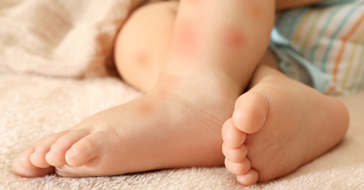 أنواع حساسية الجلد المفاجئة عند الأطفال