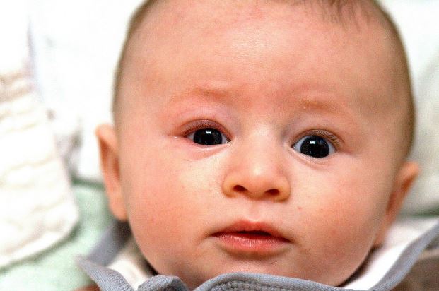 أسباب التهاب عيون الرضيع وتأثيرها على الإبصار