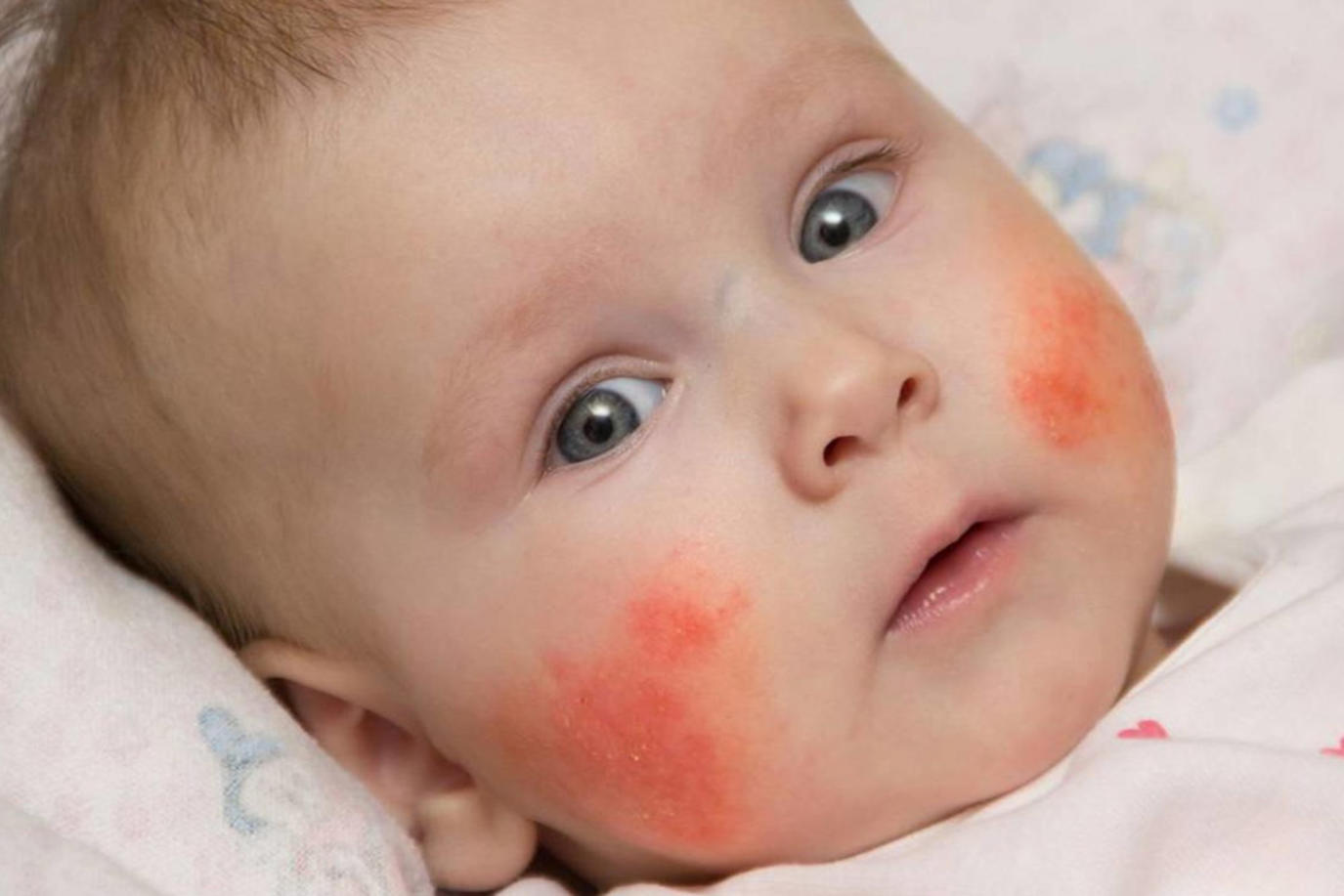 أسباب ظهور بقع حمراء على جلد الرضيع