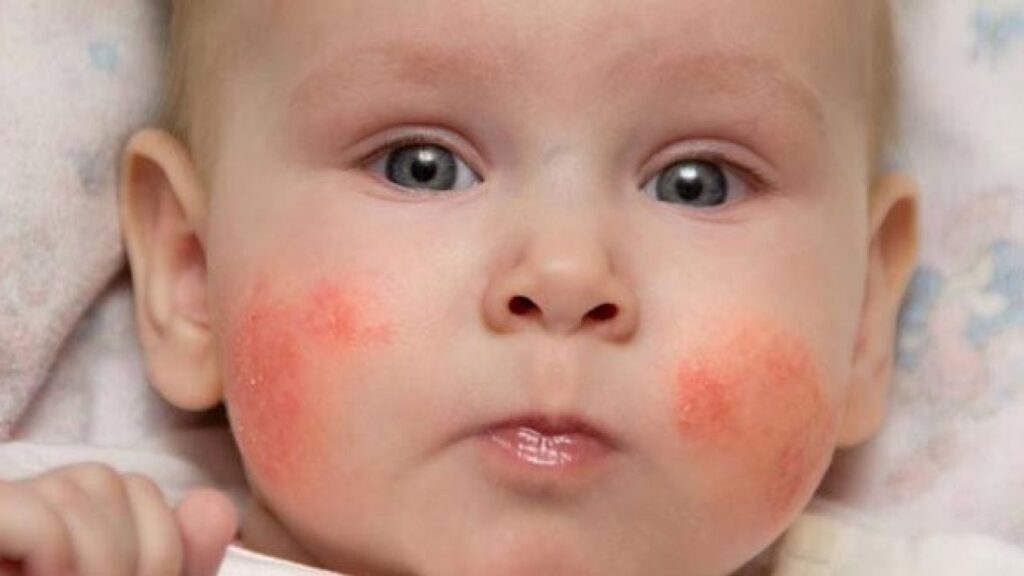 أسباب ظهور بقع حمراء مع الحمى على جلد الرضيع
