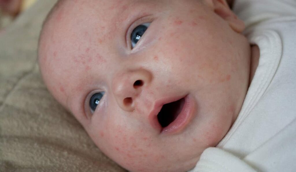 أسباب ظهور بقع حمراء من دون حكة على جلد الرضيع