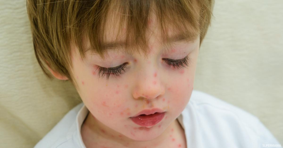 أسباب الطفح الجلدي عند الأطفال