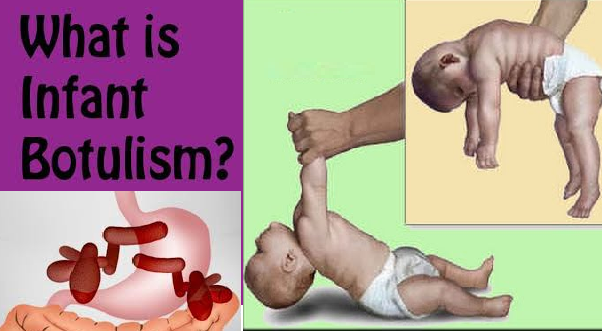 أنواع التسمم الوشيقي عند الرضع