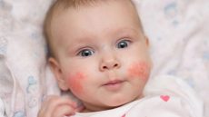 حساسية الجلد عند الأطفال الأسباب وطرق العلاج