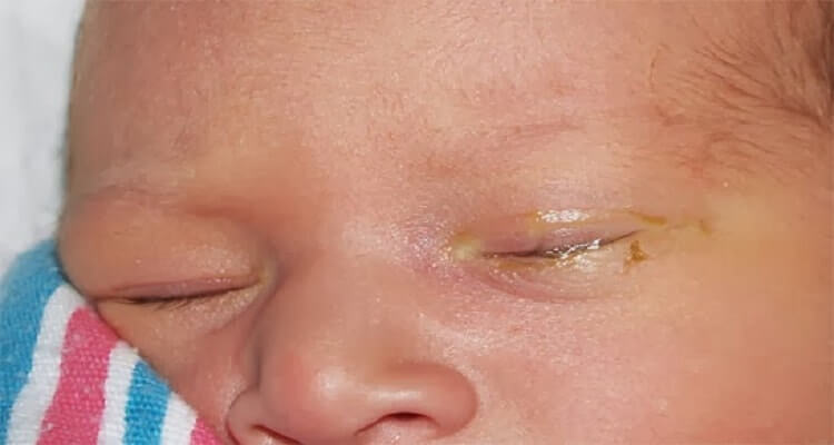 علاج إفرازات العين عند الرضع