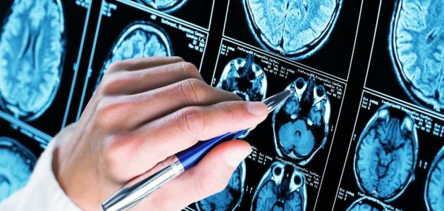 علاج ضمور المخ البسيط عند الرضع