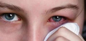 علاج رمد العين عند الأطفال