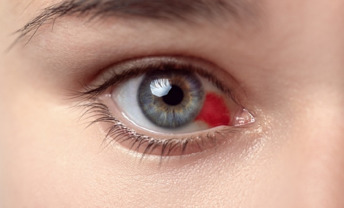 علاج ظهور نقطة حمراء في بياض العين عند الأطفال طلاب نت 5155