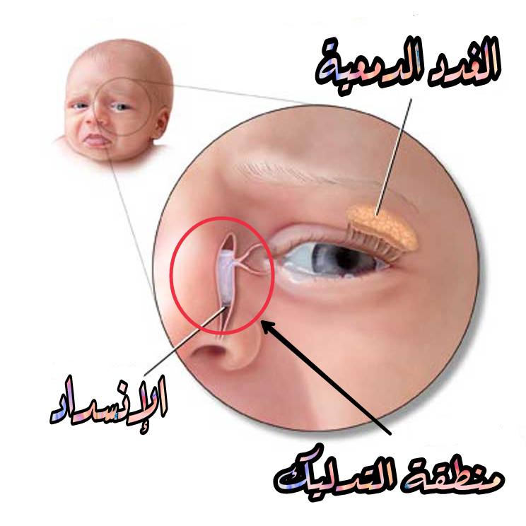 الطريقة الصحيحة لتدليك القنوات الدمعية عند الاطفال