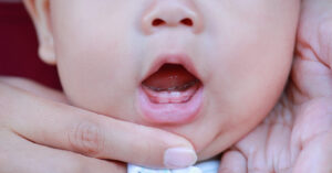 هل ظهور الناب عند الرضع قبل الأسنان طبيعي