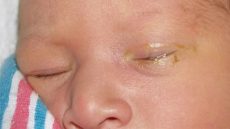 انسداد القنوات الدمعية عند الرضع وطرق علاجها