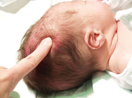 ما هي أسباب الورم الدموي الرأسي عند الطفل حديث الولادة والرضع
