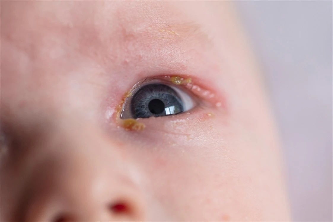أسباب إفرازات العين عند حديثي الولادة