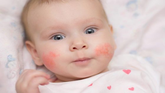 أسباب حساسية الجلد عند الأطفال حديثي الولادة