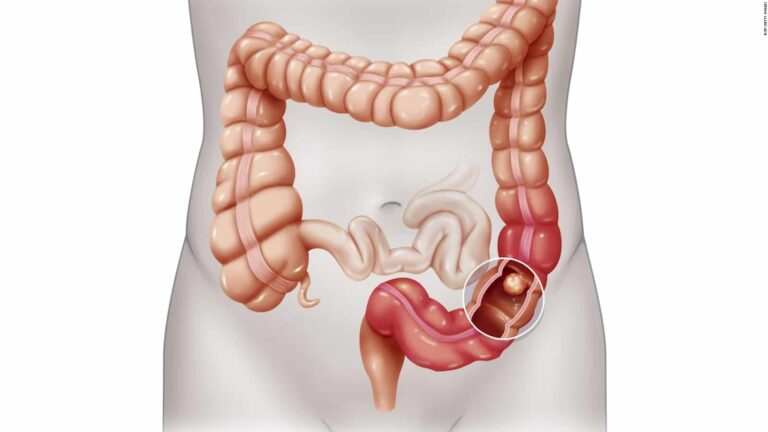 أعراض انسداد الأمعاء