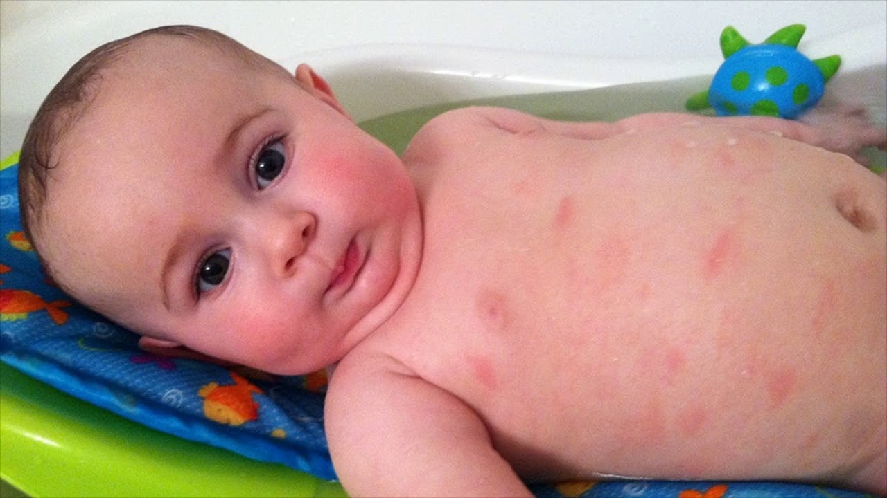 حساسية الجلد عند الأطفال حديثي الولادة