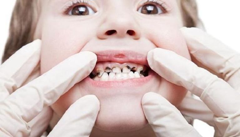 نصائح للاهتمام بأسنان طفلك من التسوس