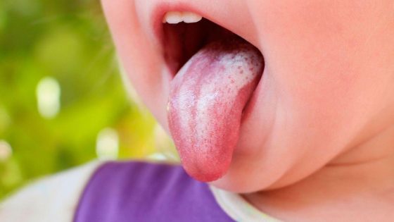 أسباب تكرار فطريات الفم عند الأطفال