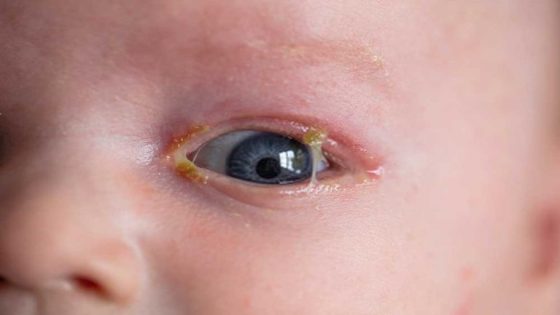 طرق إزالة إفرازات العين عند الرضع