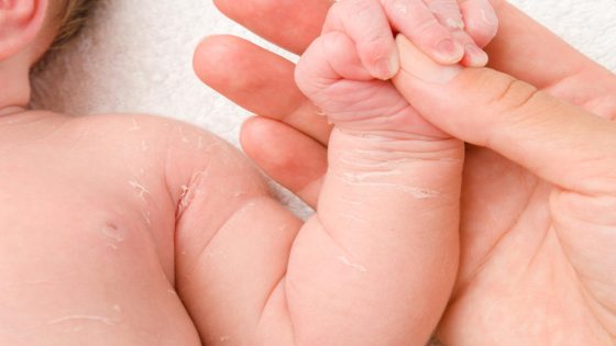 تقشر الجلد عند الأطفال الرضع