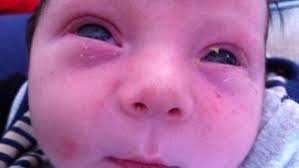 ما هي إفرازات العين عند الأطفال
