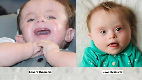 الفرق بين متلازمة داون وإدوارد من هم الأطفال إدوارد سندروم