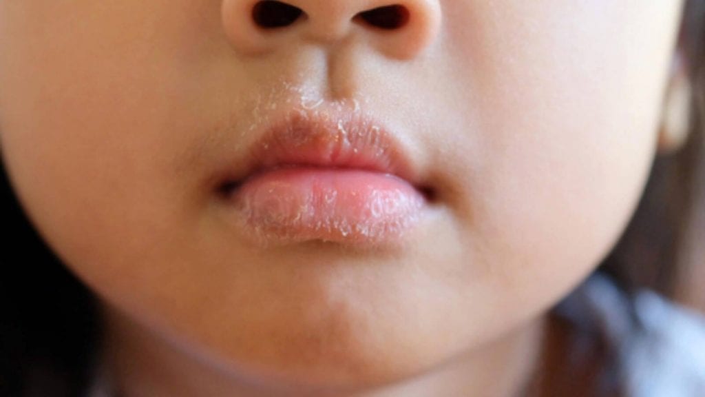 علاج تشققات الجلد عند الأطفال