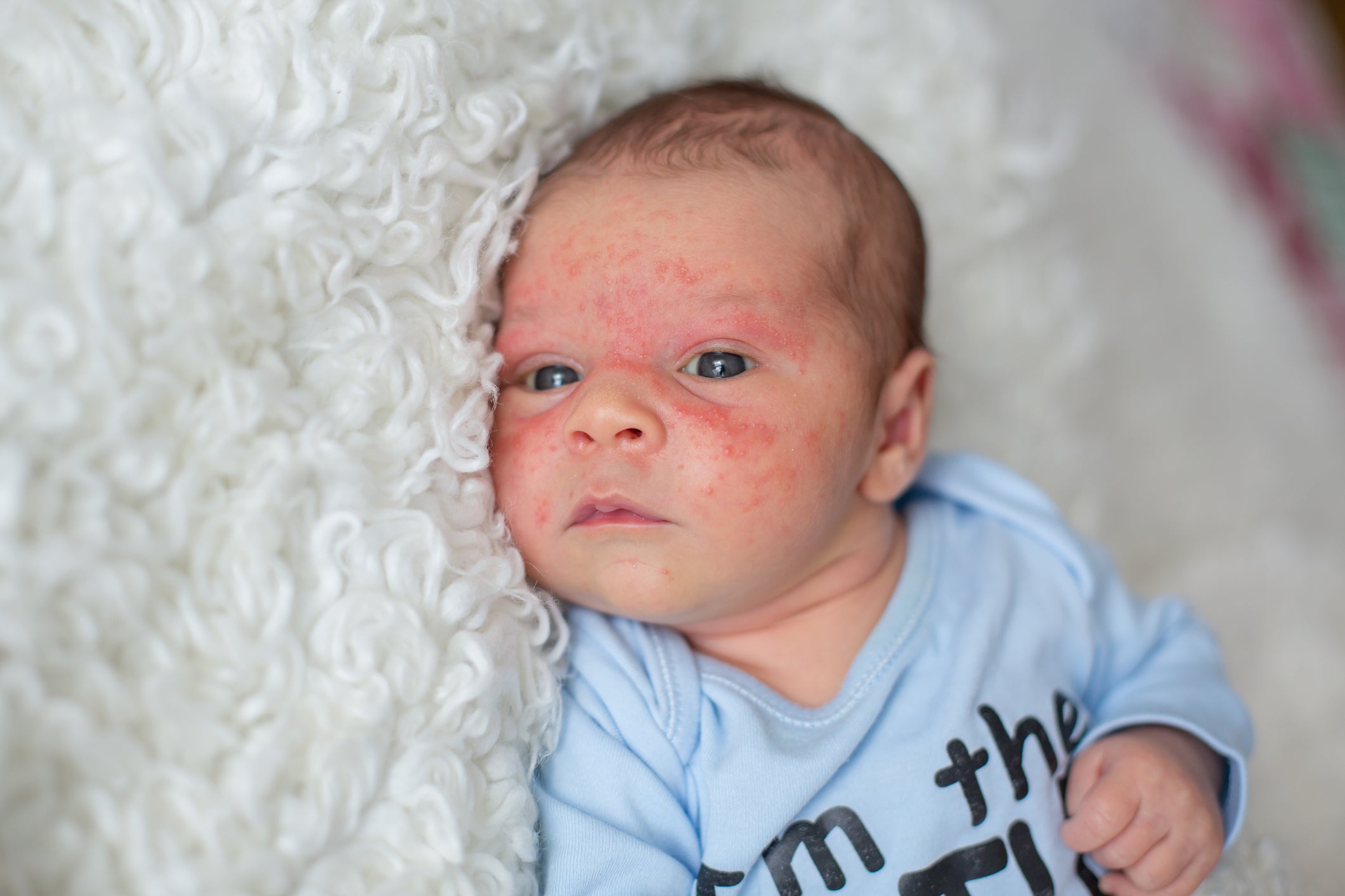 كيف تتعاملين مع أنواع الطفح الجلدي عند الرضع