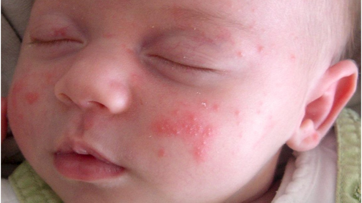 أنواع الطفح الجلدي عند الرضع