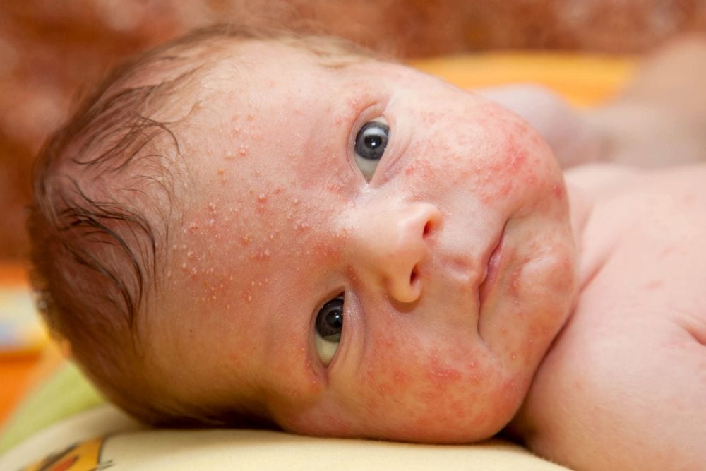 أسباب الطفح الجلدي عند الرضع 