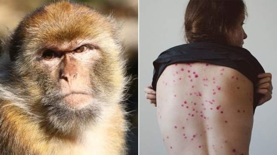 هل مرض جدري القرود معدي
