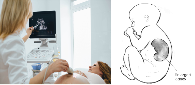 توسع حوض الكلى عند الجنين