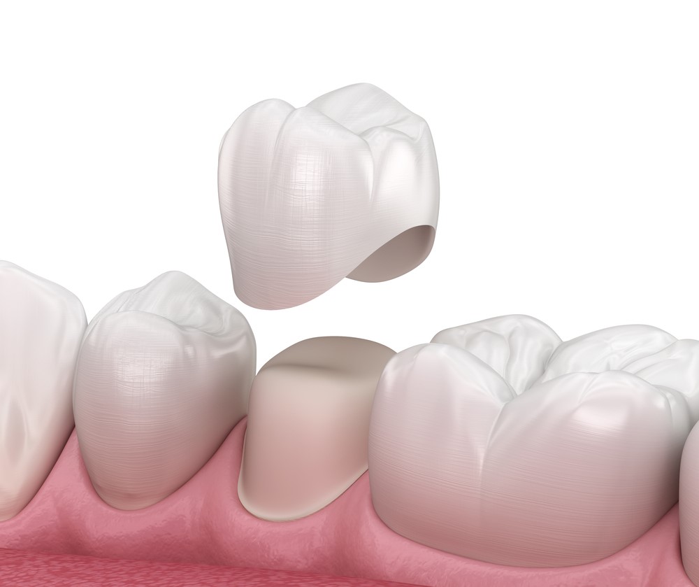 تيجان الأسنان الأنواع والطرق والتكلفة والعيوب