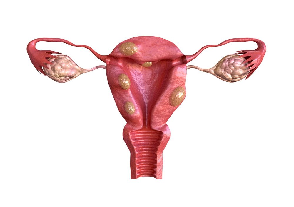 تأثير الأورام الليفية الرحمية على الحمل مدى تأثيرها