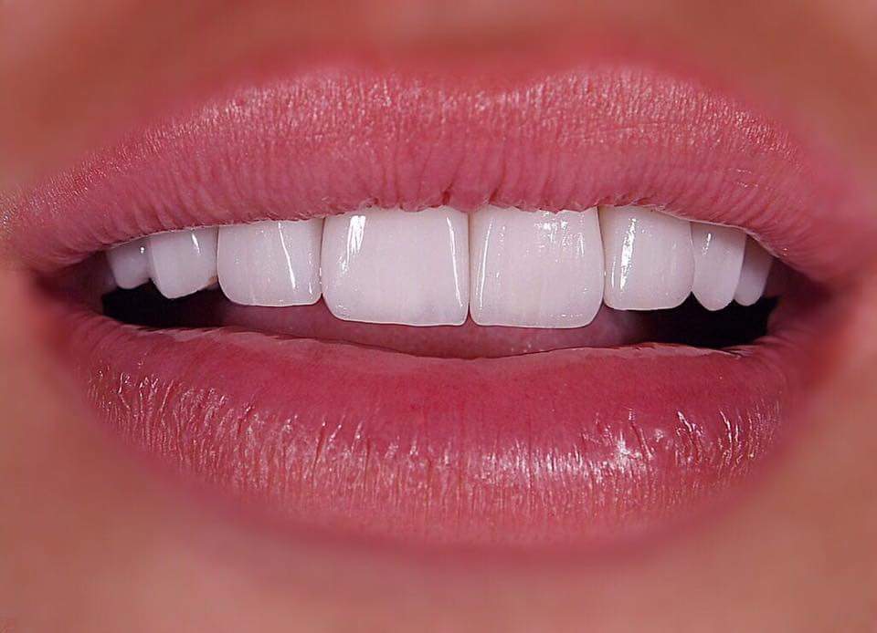 هوليود سمايل النصائح والنتائج وتكلفة هوليود سمايل الثابتة