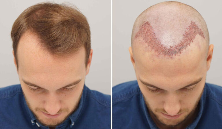 مخاطر زراعة الشعر 2022 الآثار الجانبية والوقاية