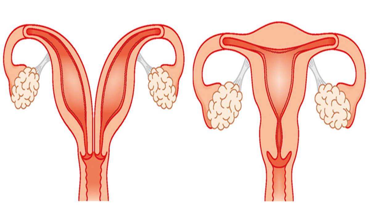 الرحم ذو القرنين الأعراض والأسباب والعلاج