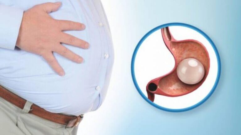 كبسولةُ المعدةِ خطوات العلاج والنتائج تجربتي