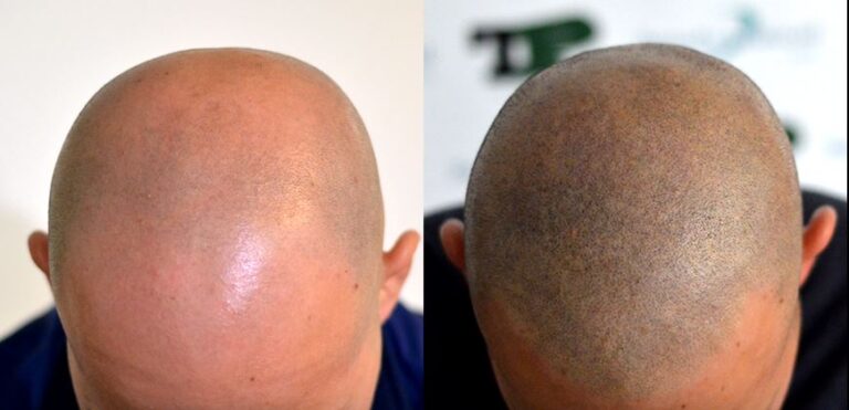 صبغ الفروة المجهري Scalp Micropigmentation وأضرارها