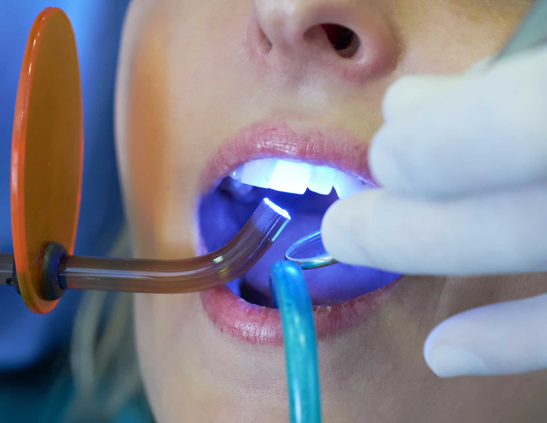 فوائد تبييض الأسنان بالليزر